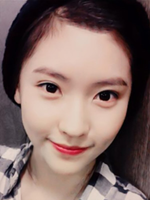 埋埋蛋白線.提升術(shù)后恢復(fù)記錄分享還有對比照