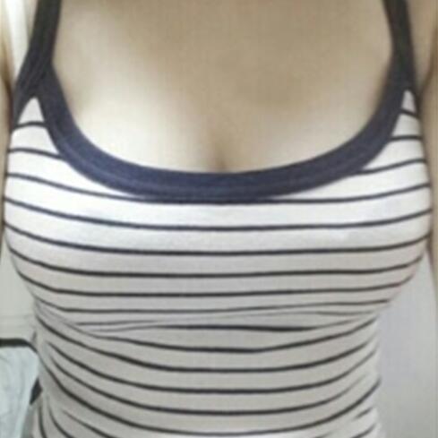 自體脂肪隆胸手術(shù)價格21800做的，恢復(fù)過程圖分享