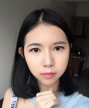 自體脂肪填充恢復(fù)日志 自體脂肪填充太陽穴+額頭