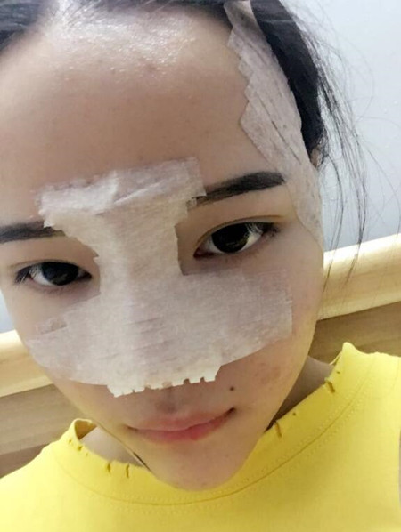 我的硅膠隆鼻+自體脂肪豐下巴+自體脂肪豐太陽(yáng)穴恢復(fù)果案例日記