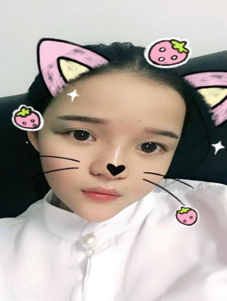 我的硅膠隆鼻+自體脂肪豐下巴+自體脂肪豐太陽(yáng)穴恢復(fù)果案例日記