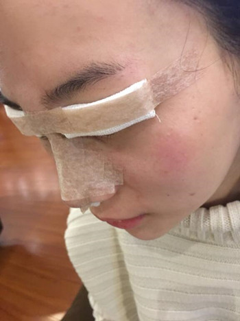我的膨體隆鼻+雙眼皮手術(shù)讓我的顏值蹭蹭上升 內(nèi)有恢復(fù)果對(duì)比圖哦