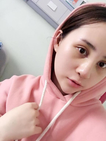 我的膨體隆鼻+雙眼皮手術(shù)讓我的顏值蹭蹭上升 內(nèi)有恢復(fù)果對(duì)比圖哦