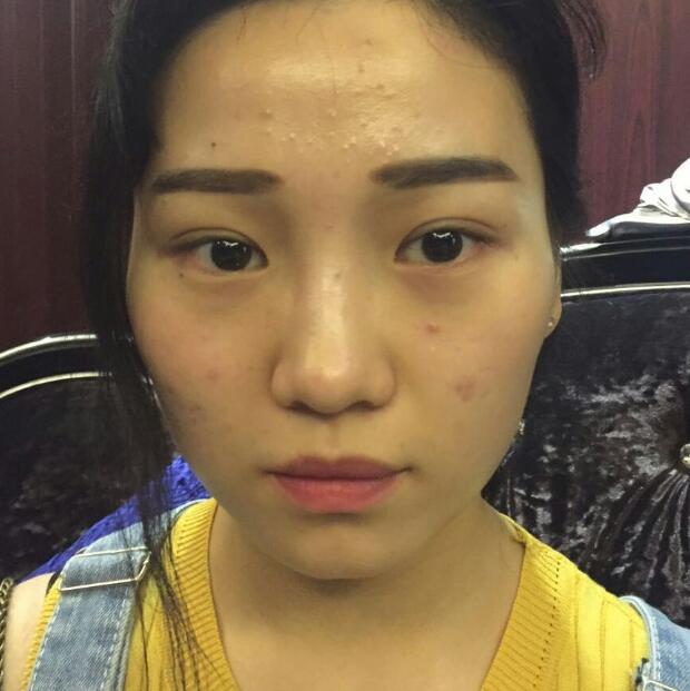 玻尿酸墊下巴手術(shù)恢復(fù)全過程圖片分享