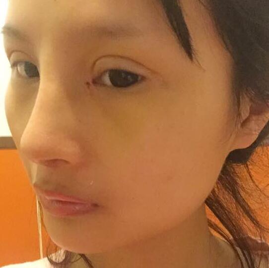自體脂肪隆鼻+割雙眼皮的恢復(fù)過程讓我找到了自信