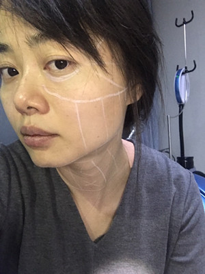 做了高強(qiáng)度聚焦超聲，果還不錯(cuò)，想把經(jīng)歷分享給大家