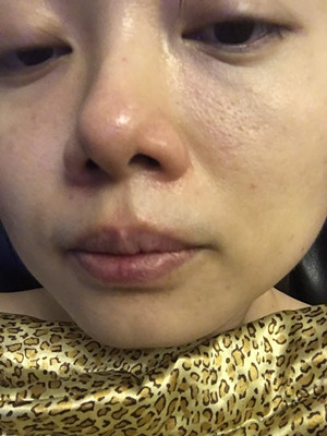 做了高強(qiáng)度聚焦超聲，果還不錯(cuò)，想把經(jīng)歷分享給大家