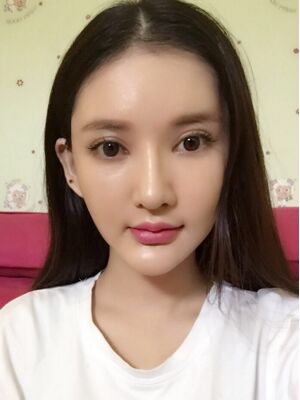 面部埋埋蛋白線.提升術后照片，皮膚緊致不少了