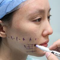 蛋白線面部埋埋蛋白線.提升手術(shù)價格15000元，果不錯分享給大家