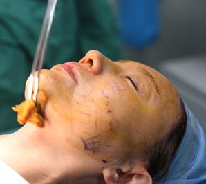 面部埋埋蛋白線.提升手術(shù)