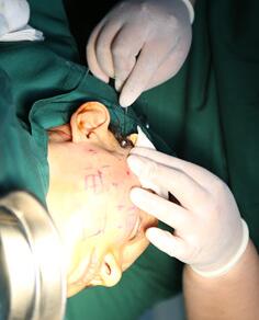 面部埋埋蛋白線.提升手術(shù)