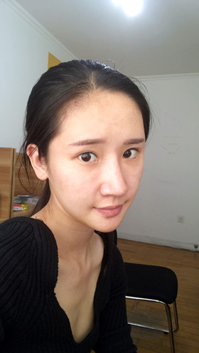 56000元做的自體脂肪填充蘋果肌+太陽穴，大家來看看果怎么樣