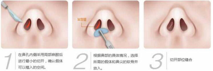 硅膠假體隆鼻過程和隆鼻前后圖片，真實案例分享