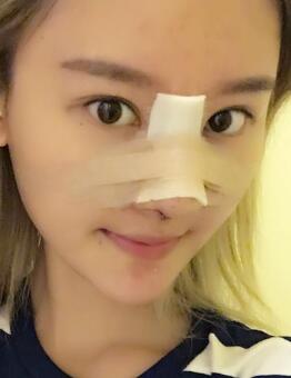 硅膠假體隆鼻過程和隆鼻前后圖片，真實案例分享