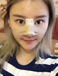 硅膠假體隆鼻過程和隆鼻前后圖片，真實案例分享