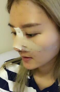 硅膠假體隆鼻過程和隆鼻前后圖片，真實案例分享