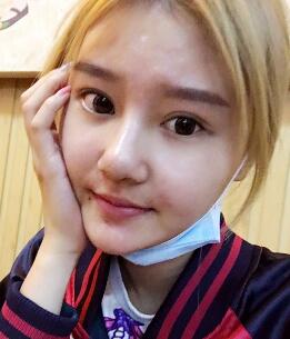 硅膠假體隆鼻過程和隆鼻前后圖片，真實案例分享