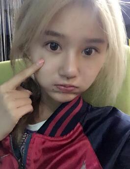 硅膠假體隆鼻過程和隆鼻前后圖片，真實案例分享