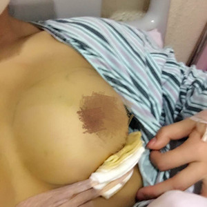 50000元做的自體脂肪隆胸，還有前后對(duì)比照片以及注意事項(xiàng)哦