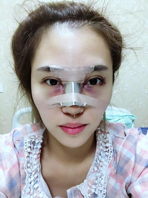 長沙華韓華美做的隆鼻整形，感覺果還不錯(cuò)哦!