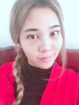 長沙華韓華美做的隆鼻整形，感覺果還不錯(cuò)哦!