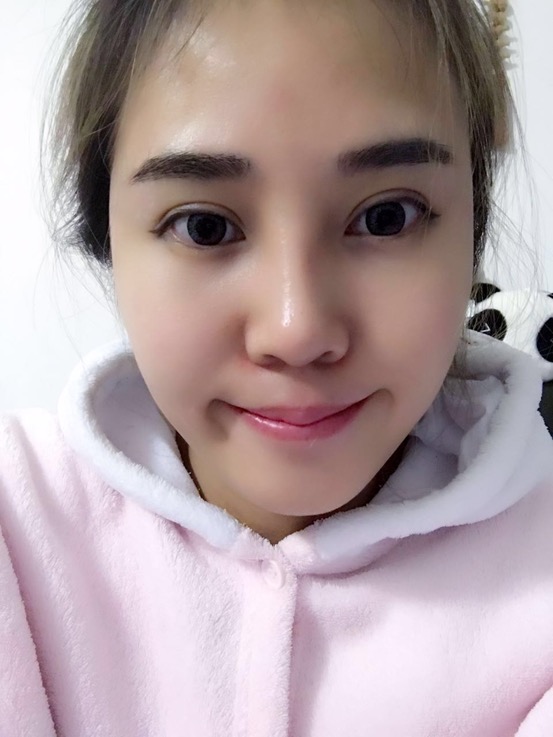 長沙華韓華美做的隆鼻整形，感覺果還不錯(cuò)哦!