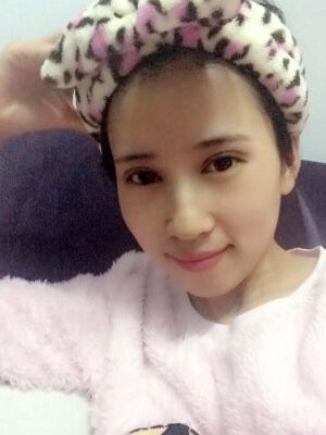 切開雙眼皮恢復(fù)過程，手術(shù)很成功哦