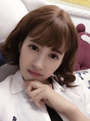 切開雙眼皮恢復(fù)過程，手術(shù)很成功哦