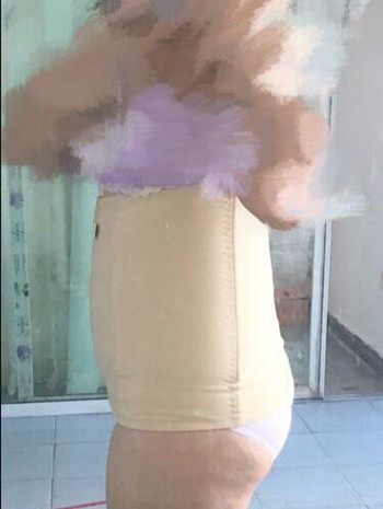 腰腹吸脂整形花了我兩萬(wàn)多的錢(qián)  果真的挺不錯(cuò)的