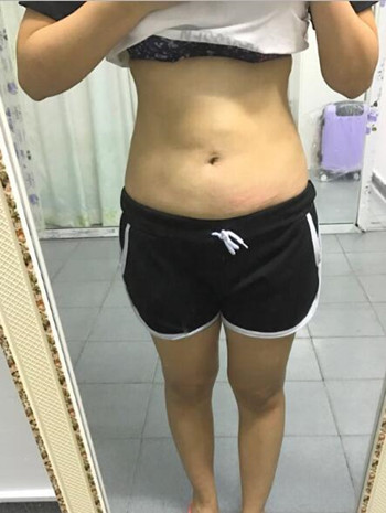 腰腹吸脂整形花了我兩萬(wàn)多的錢(qián)  果真的挺不錯(cuò)的