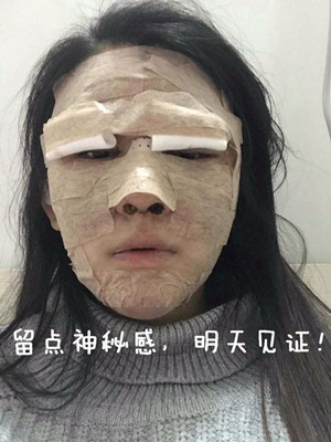 做了詳細部脂肪填充+雙眼皮+假體隆鼻，來看看果如何