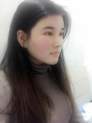 做了詳細部脂肪填充+雙眼皮+假體隆鼻，來看看果如何