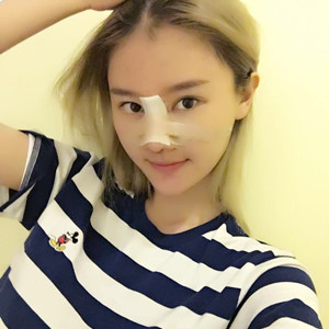 硅膠隆鼻2個月啦，8000元做的哦!