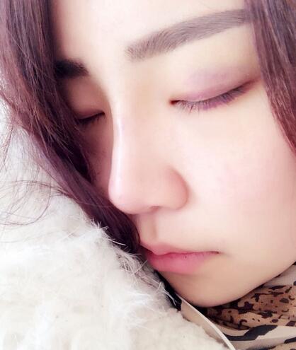 耳軟骨墊鼻尖三個(gè)月圖 耳軟骨墊鼻尖+硅膠隆鼻