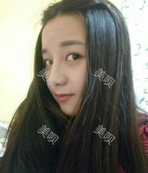 韓式隆鼻整形真實恢復(fù)期圖片，自然不夸張