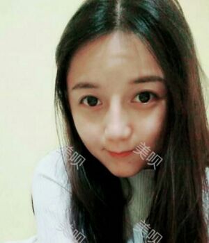 韓式隆鼻整形真實恢復(fù)期圖片，自然不夸張