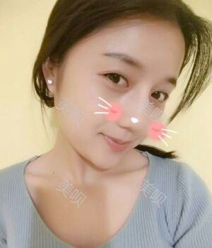 韓式隆鼻整形真實恢復(fù)期圖片，自然不夸張