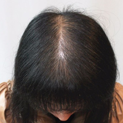 杭州金銀磊頭發(fā)種植案例