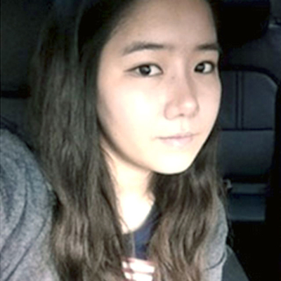 寧波薇琳劉波硅膠假體隆鼻案例