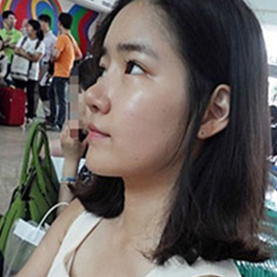 寧波薇琳劉波硅膠假體隆鼻案例