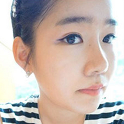 寧波薇琳劉波硅膠假體隆鼻案例