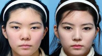 隆鼻的價格受到很多因素的影響