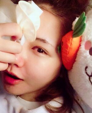 韓式定點雙眼皮前后對比圖，雙眼有神多了