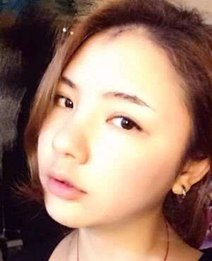 韓式定點雙眼皮前后對比圖，雙眼有神多了