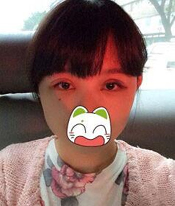 割雙眼皮+開眼角一共8800  快來圍觀我的恢復經(jīng)歷