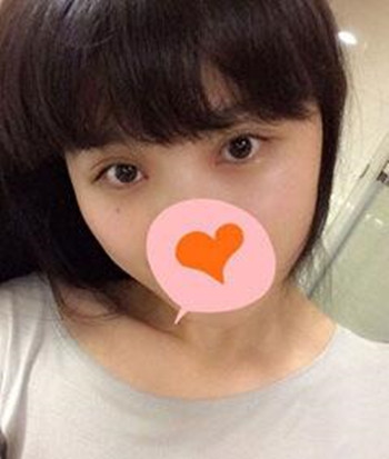 割雙眼皮+開眼角一共8800  快來圍觀我的恢復經(jīng)歷