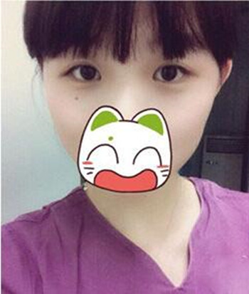 割雙眼皮+開眼角一共8800  快來圍觀我的恢復經(jīng)歷