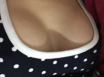 我的假體豐胸逆襲之路  親身體驗