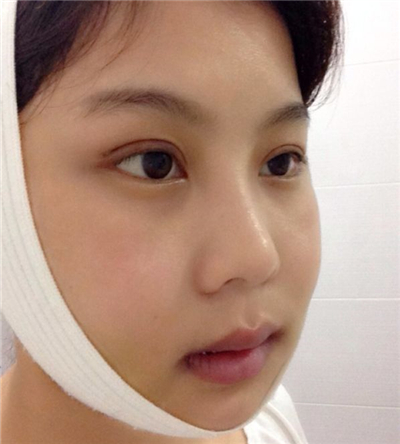 蘇州愛思特呂金陵磨下頜角案例