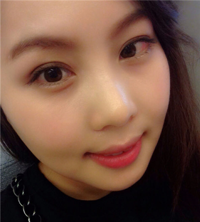 蘇州愛思特呂金陵磨下頜角案例